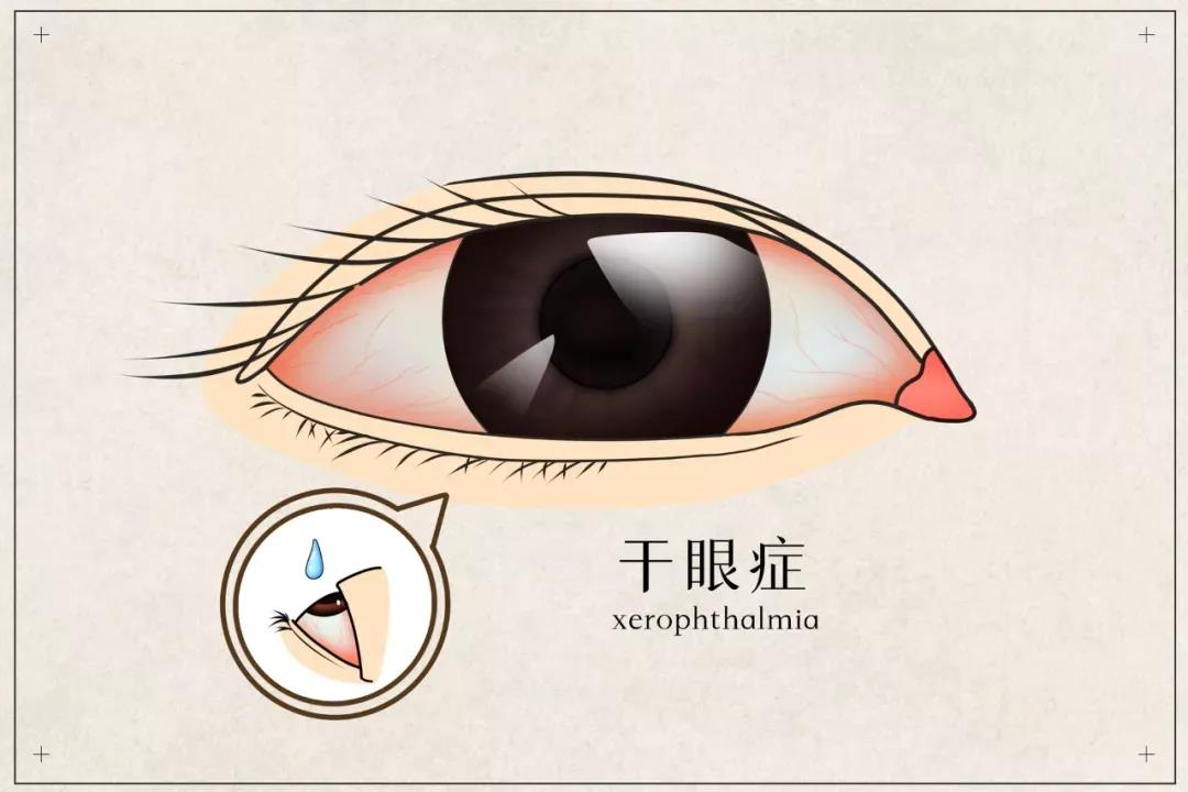 干眼患者福音来啦！(图2)